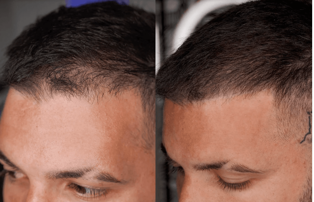 RECLAIM SET BY STEVEY G | 6 PIGMENTOS SMP | PERMA BLEND LUXEPerma Blend LUXE — Reclaim Set by Stevey G | 6 Pigmentos SMP | México Colección especializada para Scalp Micropigmentation desarrollada con el experto internacional Stevey G. Pigmentos formulados
