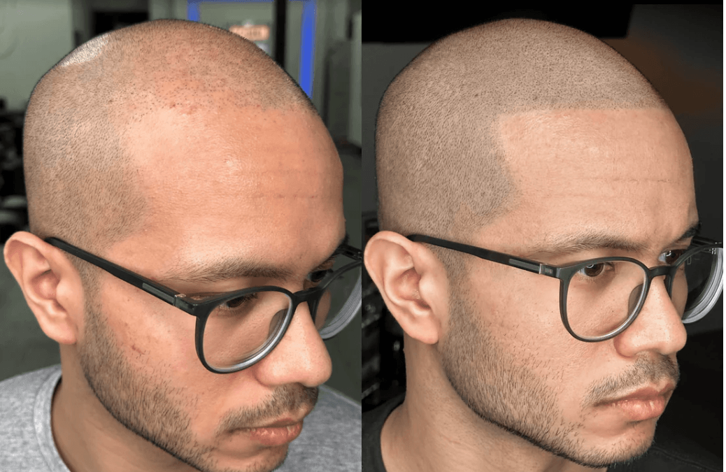 RECLAIM SET BY STEVEY G | 6 PIGMENTOS SMP | PERMA BLEND LUXEPerma Blend LUXE — Reclaim Set by Stevey G | 6 Pigmentos SMP | México Colección especializada para Scalp Micropigmentation desarrollada con el experto internacional Stevey G. Pigmentos formulados
